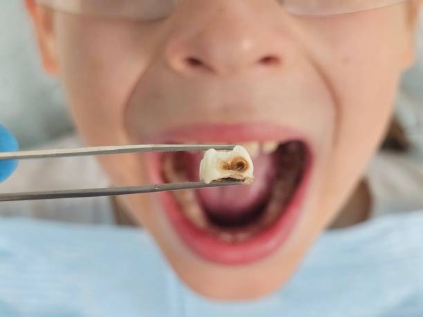 Best Emergency Tooth Extraction in Bourbonnais, IL